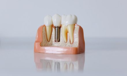 Tratamentul cu Implanturi Dentare – Totul despre Înlocuirea Dinților Lipsă